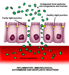 celiac disease and its increased intestinal permeability